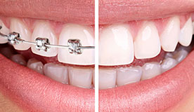 clear-aligner