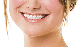 Keramikbrackets