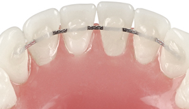retainer