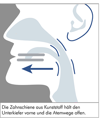 Herausnehmbare Spange