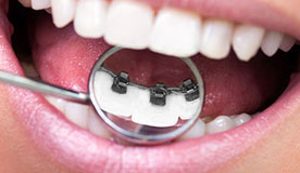 Lingualbrackets